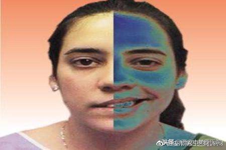 什么叫面肌痉挛,非典型面肌痉挛如何治疗