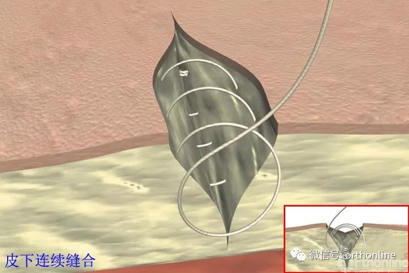 常用的手术缝合方法图,临床常见常用伤口缝合方法
