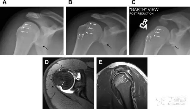 值夜班急救措施,放射科容易漏诊的骨折