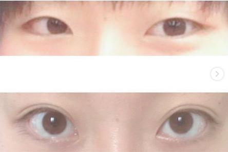 日本双眼皮整形视频,日本整容大师演示