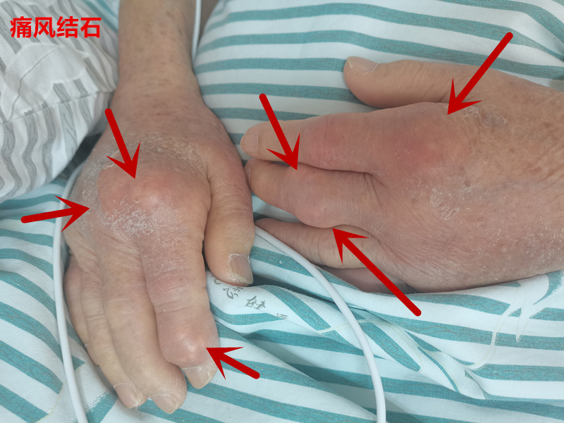 每天吃两片小苏打对痛风有好处吗,尿酸高痛风喝小苏打有什么好处吗