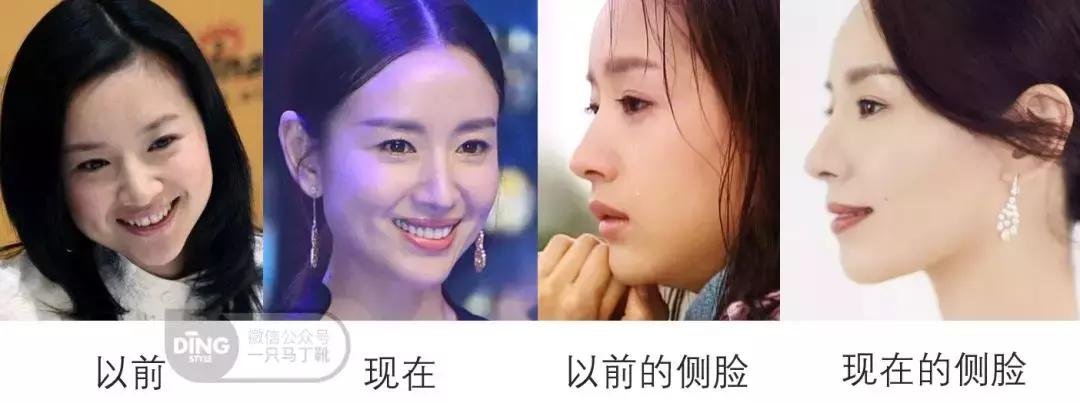 凹面型侧脸怎么改善,凹面型侧脸是怎么造成的