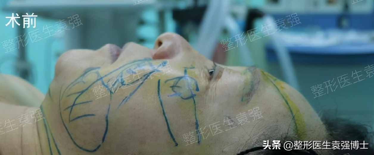 45岁的女人做侧拉皮,48岁做拉皮手术亲身经历