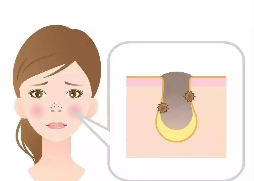 最简单最实用的去黑头方法,简单有效的去黑头方法