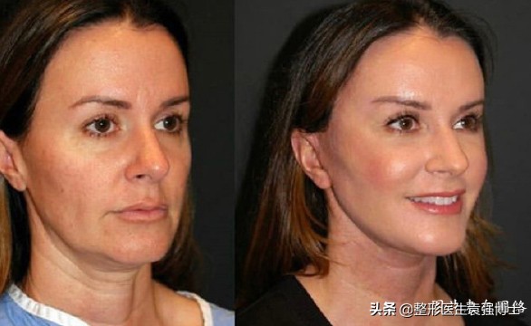 拉皮手术维持期满后会更衰老吗,脖子拉皮手术能维持多久