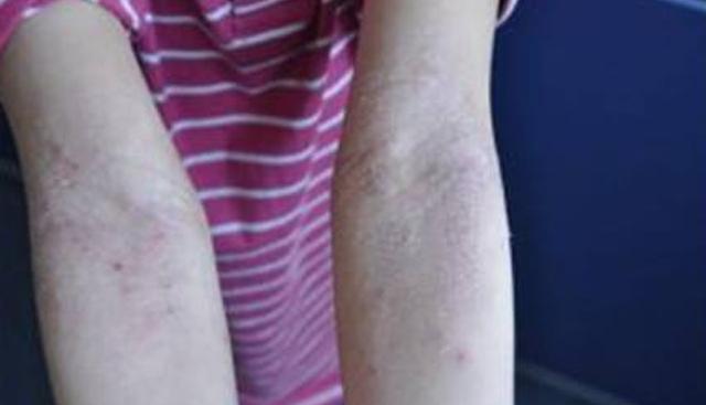 湿疹严重有什么忌口,湿疹过来人的独家秘籍