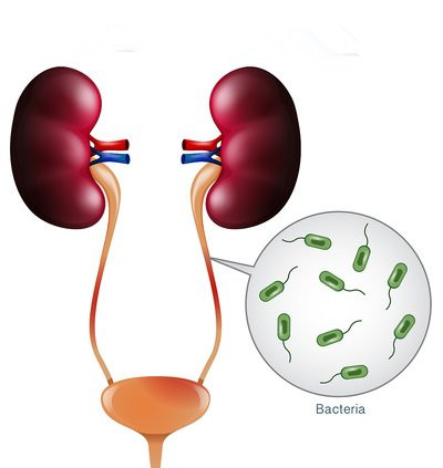 反复膀胱炎怎么根治,反反复复膀胱炎是怎么回事
