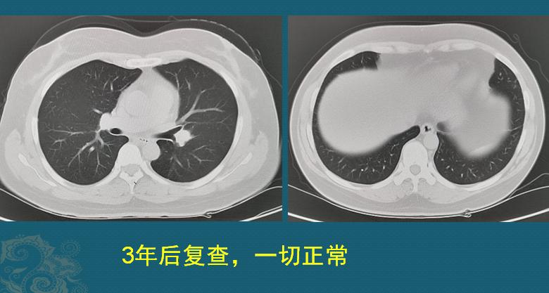 癌症中晚期怎么治疗最好,怎样告诉癌症晚期患者的病情