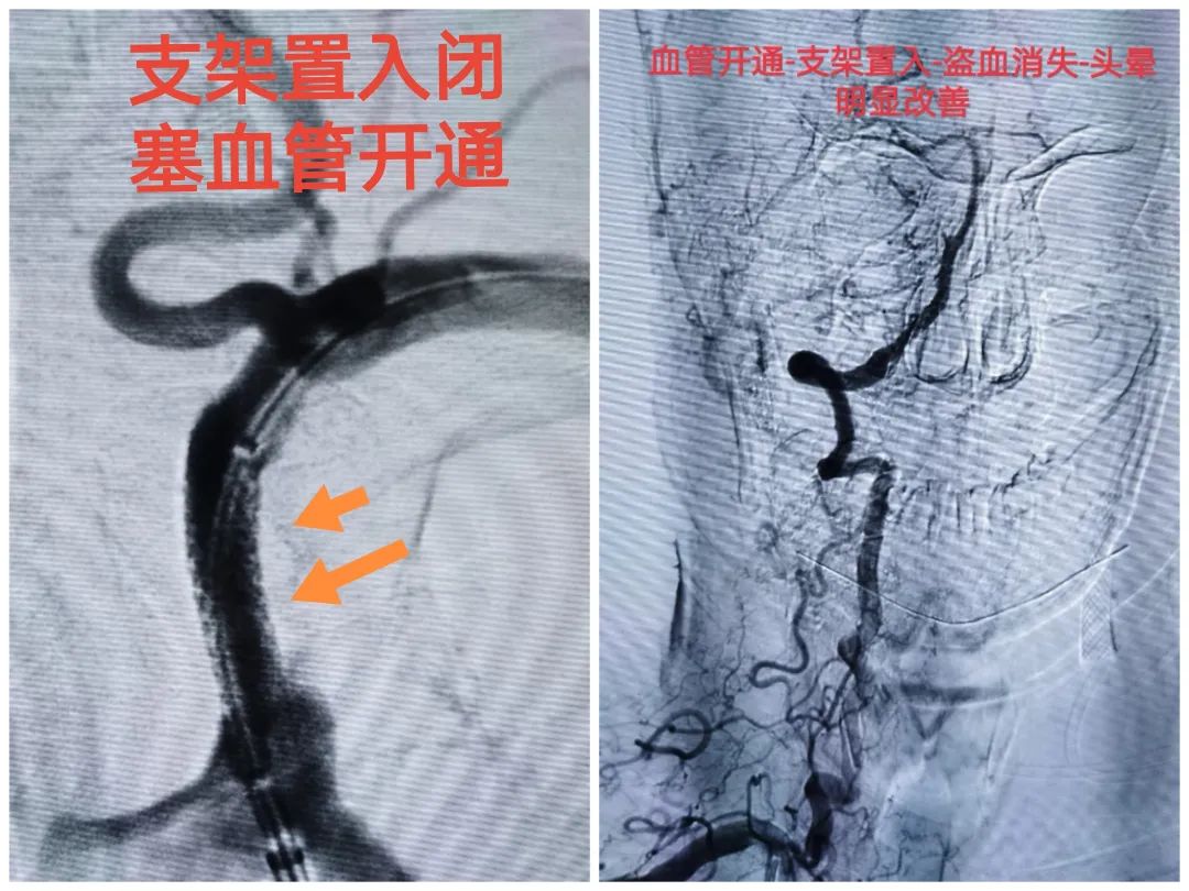 脑卒中发生时自己怎么自救,脑卒中急救黄金1小时