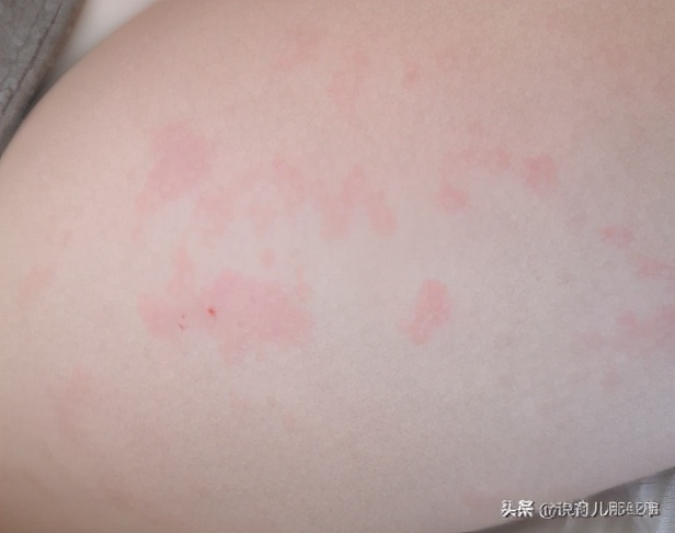 很恐怖的过敏图片,过敏发朋友圈的真实图片