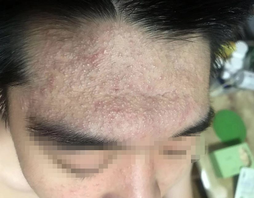 屏障受损起闭口粉刺多长时间能好,不要小看了闭口粉刺