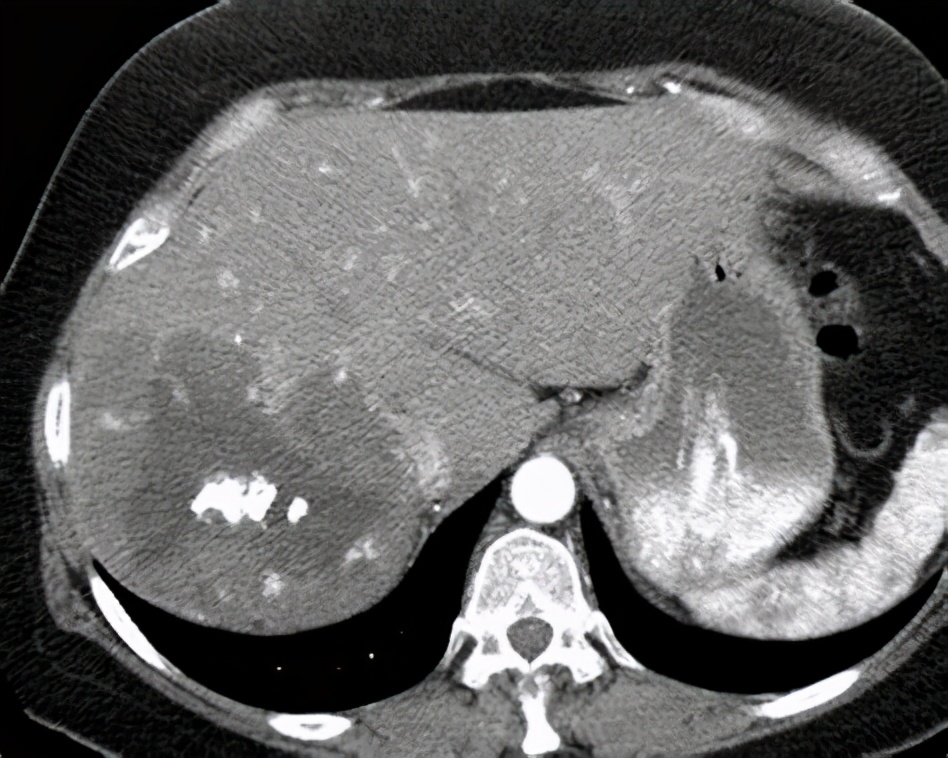 为什么肝血管瘤医生建议不用管,有了肝血管瘤要注意什么