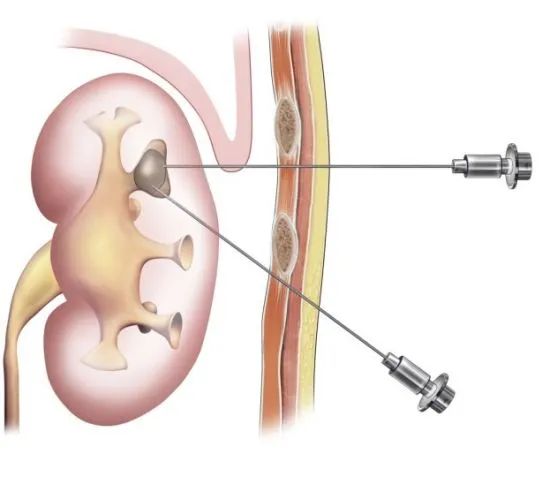 掌健识健康百科,肾脏引起的手指肿胀应该怎么办