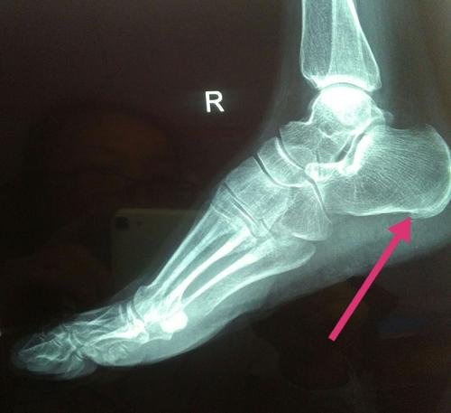 脚后跟长骨刺要不要紧,脚后跟长骨刺可以打封闭吗