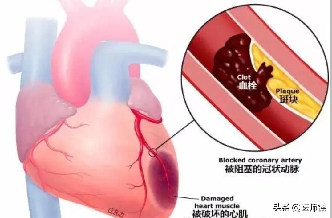 阿司匹林预防心血管,阿司匹林预防心脏的副作用与危害