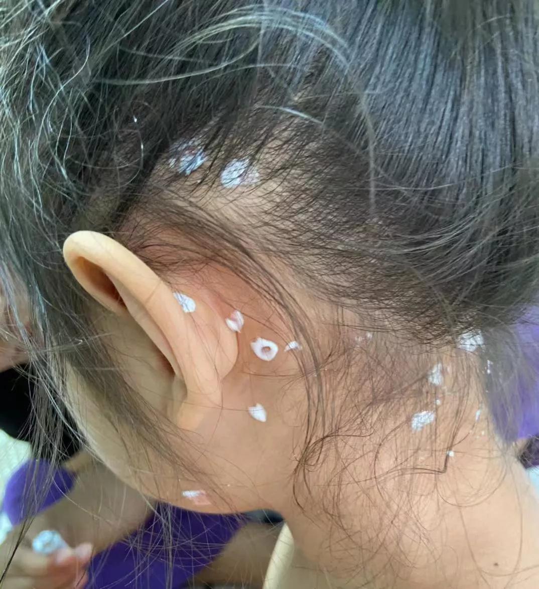 接触出水痘的孩子要再打疫苗吗,我家宝宝打疫苗后发烧