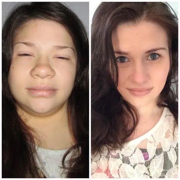 昨晚脸又痛肿了,为什么早上起来感觉脸肿了一圈