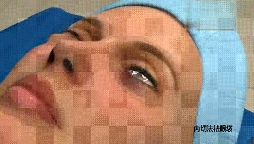 祛眼袋手术后多久恢复自然,西安哪家医院祛眼袋手术做的最好