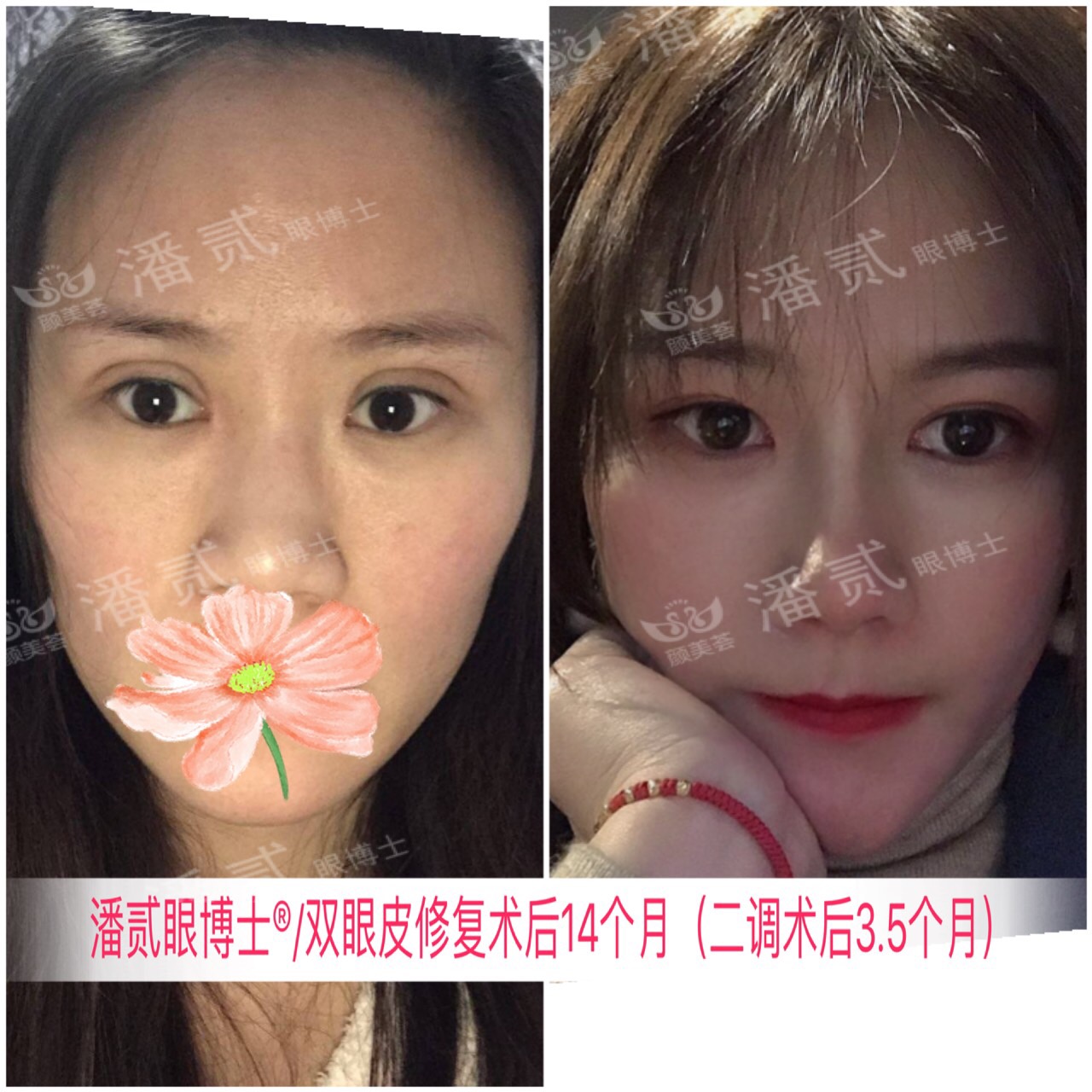 广州双眼皮凹陷修复视频,小切口双眼皮肉条修复