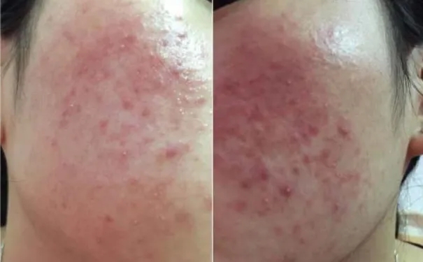 用了激素一个月后脸肿了,化妆品用了一个星期后过敏