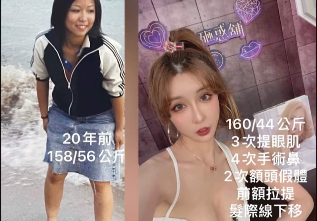 自曝整容经历网红,网红疯狂整容最后脸烂在手术台上