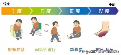 腿梗严重吗,为什么有的人脑梗心梗腿很正常