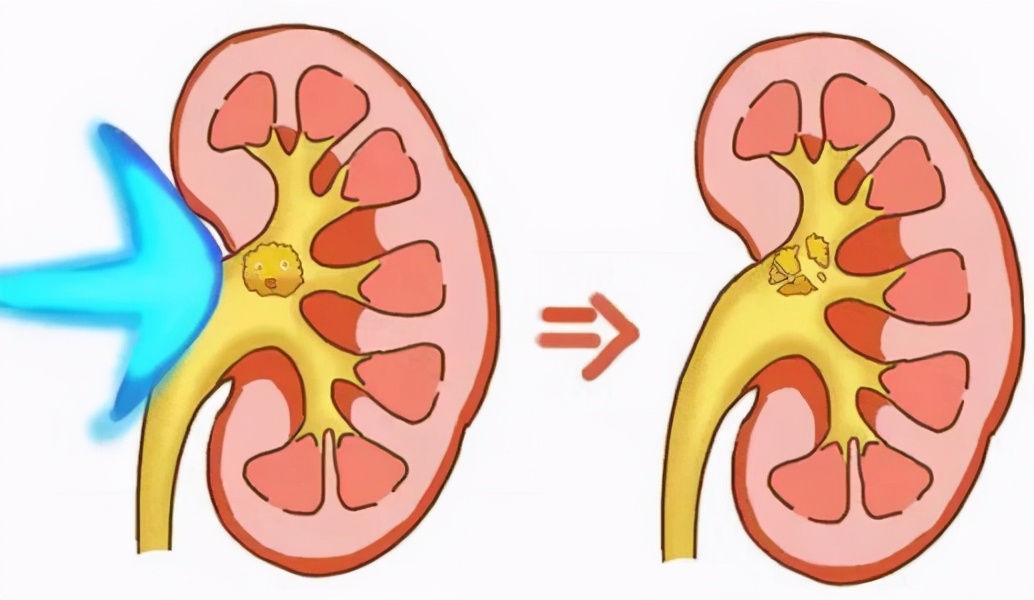体外碎石和激光的副作用和危害,输尿管结石超声波碎石后的副作用