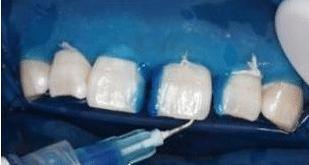 门牙裂了一条缝,门牙有缝的女人