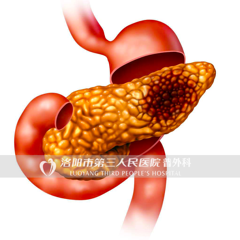 医学专家谈胰腺癌为什么这么可怕,为啥年轻人得了胰腺癌太惨了