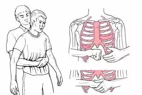 急救手册异物卡喉的唯一救命方法,异物卡喉一招可以救命视频教你