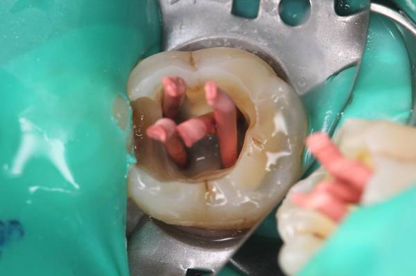 牙齿蛀牙怎么治疗,治疗蛀牙的视频