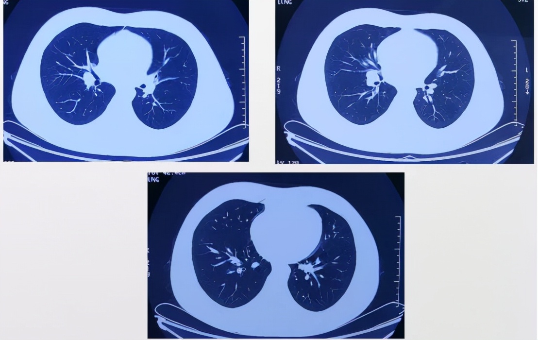 治疗后体温恢复,症状、影像仍进展,证据指向的感染竟只是迷障?
