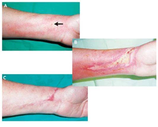 肿瘤病人药液外渗怎么办,肿瘤化疗完之后怎么治疗