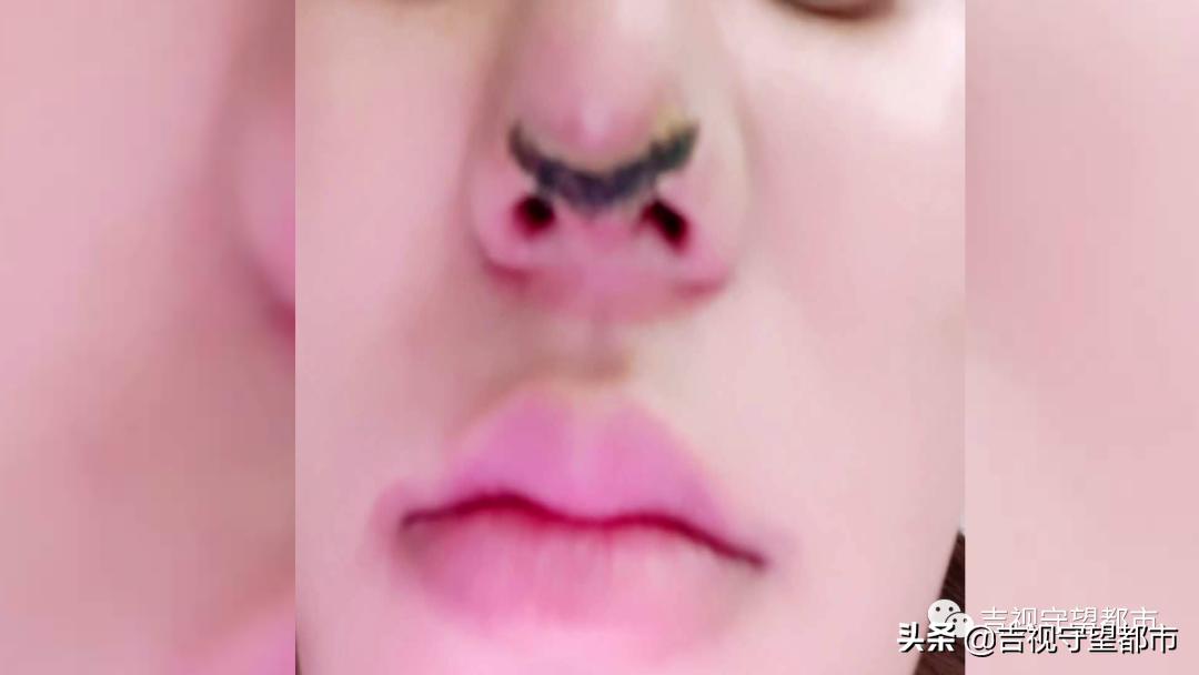 隆鼻疤痕萎缩,女子隆鼻手术后鼻子变黑