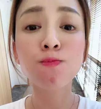 消灭痘痘最好的方法,身上的痘痘怎么消灭