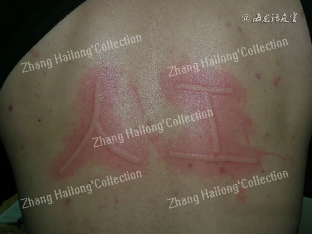 皮肤老是过敏荨麻疹怎么回事,过敏引起的荨麻疹怎么治才会好