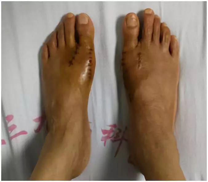 双足拇外翻需要手术吗,拇外翻矫形