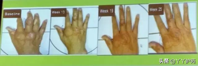 急性痛风怎么治疗,痛风治疗全程视频