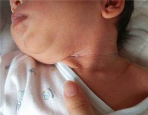 宝宝淹脖子的怎么处理,宝宝淹脖子了怎样护理