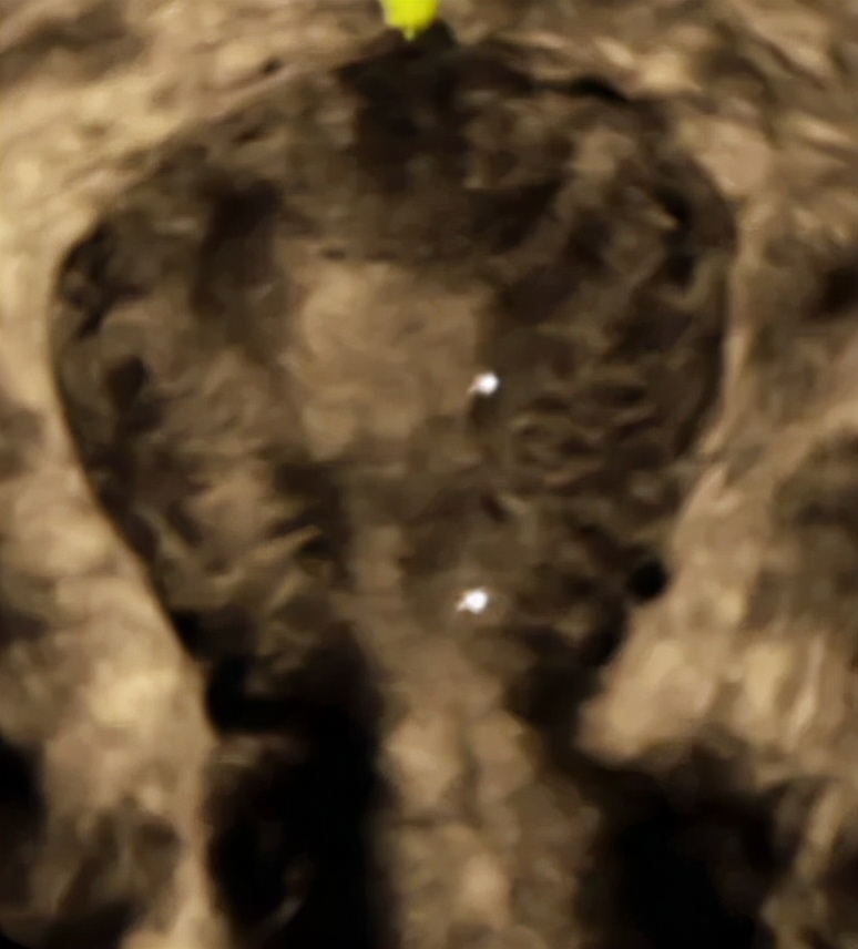 四维超声能看出宫腔粘连吗,做超声能看出来宫腔粘连吗