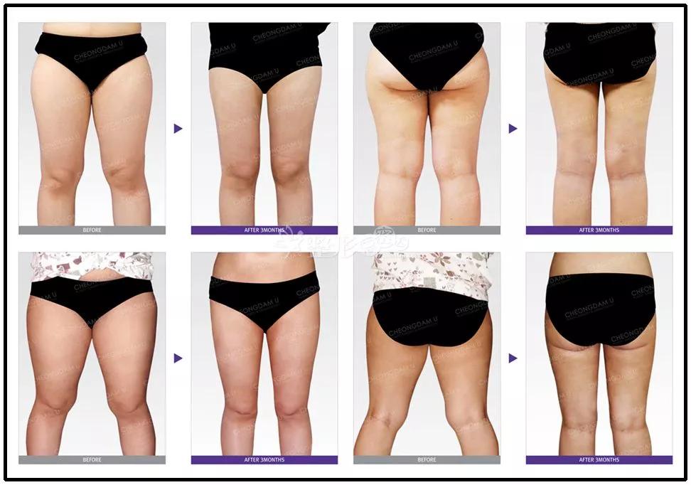 腿为啥粗都是有原因的,腿为什么会堵