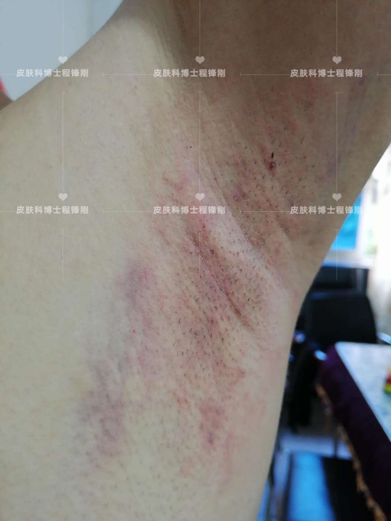 十七岁同学有遗传腋臭最好办法,遗传狐臭可以彻底根治吗