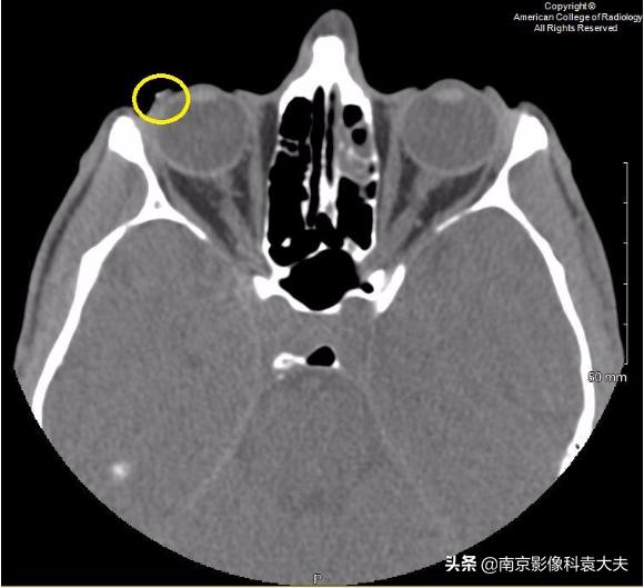 22岁男子眼睛意外失明,中年男子突然右眼失明半小时