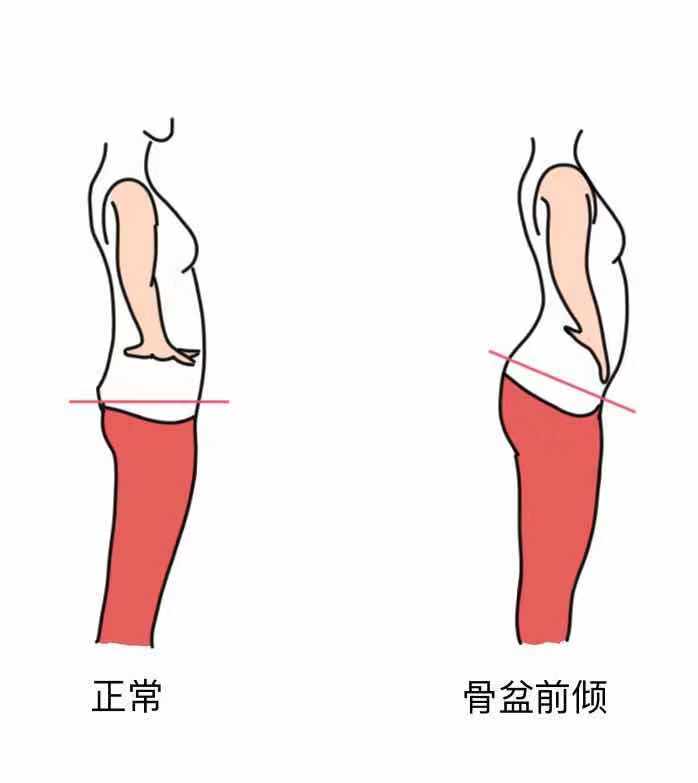 为啥大腿后侧拉伸很紧,大腿后侧筋拉伸导致疼痛能自愈吗