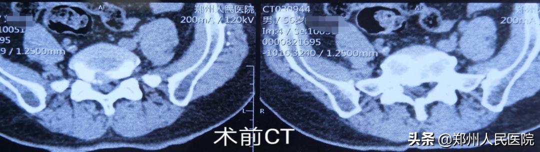 对骨科微创技术的认识,骨科手术与保守治疗对比