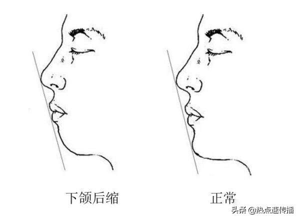 导致下巴歪的原因有哪些,下巴后缩严重的案例