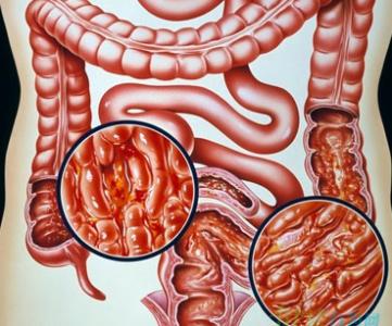 溃疡性结肠炎脓血便长期控制不住,女41岁结肠炎的症状