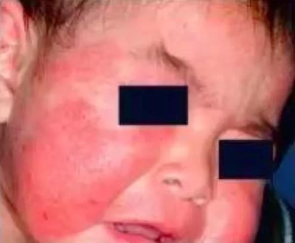 为什么湿疹疙瘩难消除,儿童湿疹抓破后难愈合怎么办