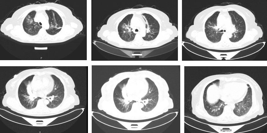 鍖荤敓鏃犳硶鍒ゆ柇缁撹妭鐥呰繕鏄粨鏍哥梾,鏈夎偤缁撴牳鐥呭彶鍗佸嚑骞存煡鍑鸿偤缁撹妭