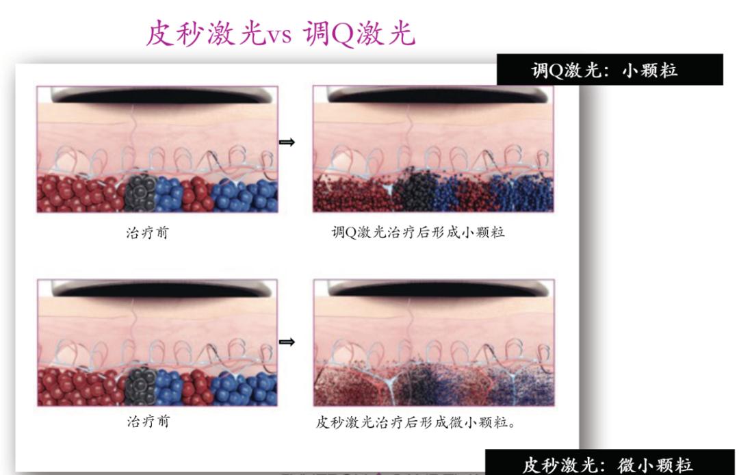 皮秒激光祛斑能保护表皮不受损伤,超皮秒激光祛斑的危害与效果视频